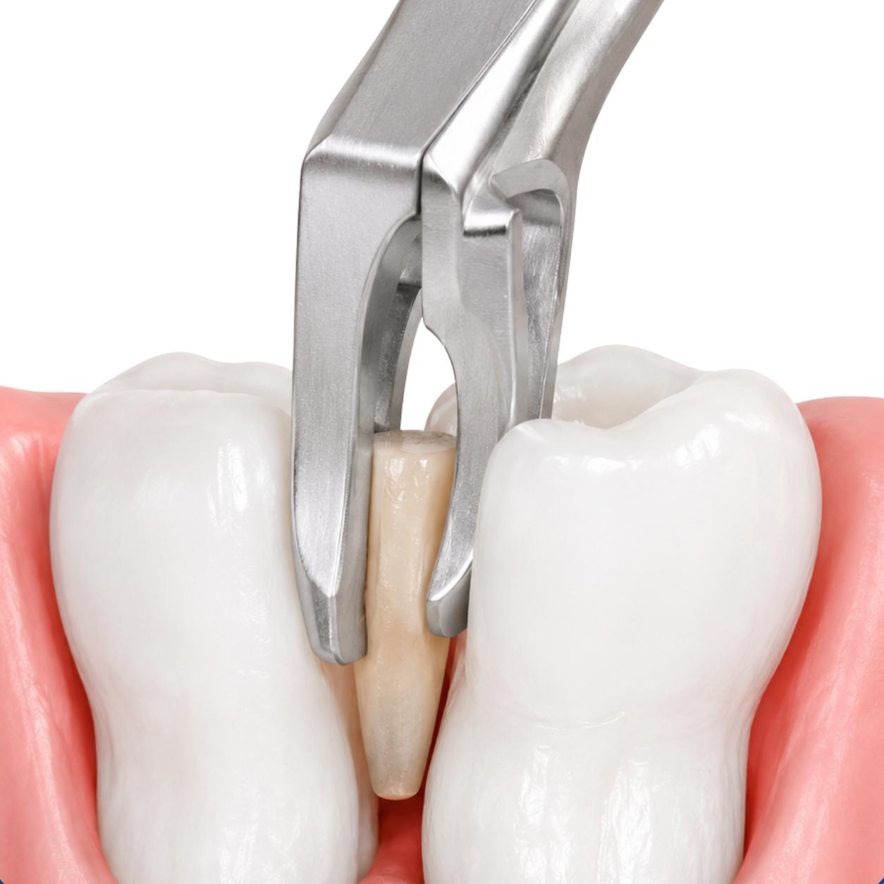 Extractor dental de acero inoxidable extrayendo una raíz dental